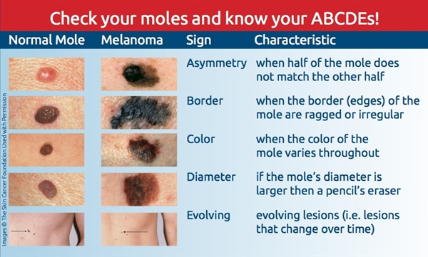 The Top 10 Thing You Need to Know about Melanoma Awareness Month ...