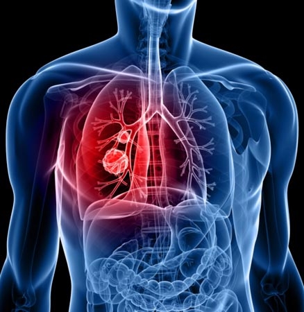 What is the incidence of lung cancer in China and/or India? ?