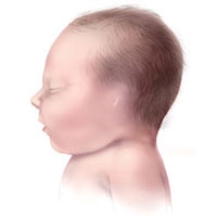 CDC - Features -Birth Defects Cleft and Craniofacial - NCBDDD