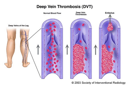 My wife having Heavy menses bleeding from last 3 days during DVT (Deep-vein thrombosis).?