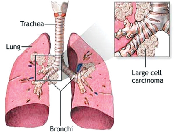 how many people develop lung cancer every year or day all over the world?