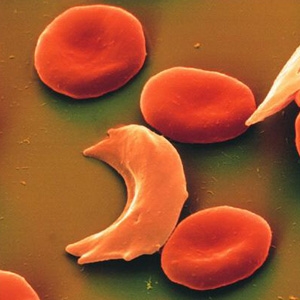 Is it possible for white people to have Sickle Cell Anemia?