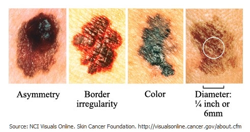 Skin Cancer Detection and Prevention Month