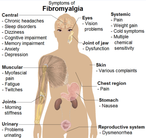 What are the Symptoms of Fibromyalgia ? – National Fibromyalgia ...